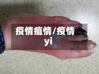 疫情疽情/疫情yi-第1张图片